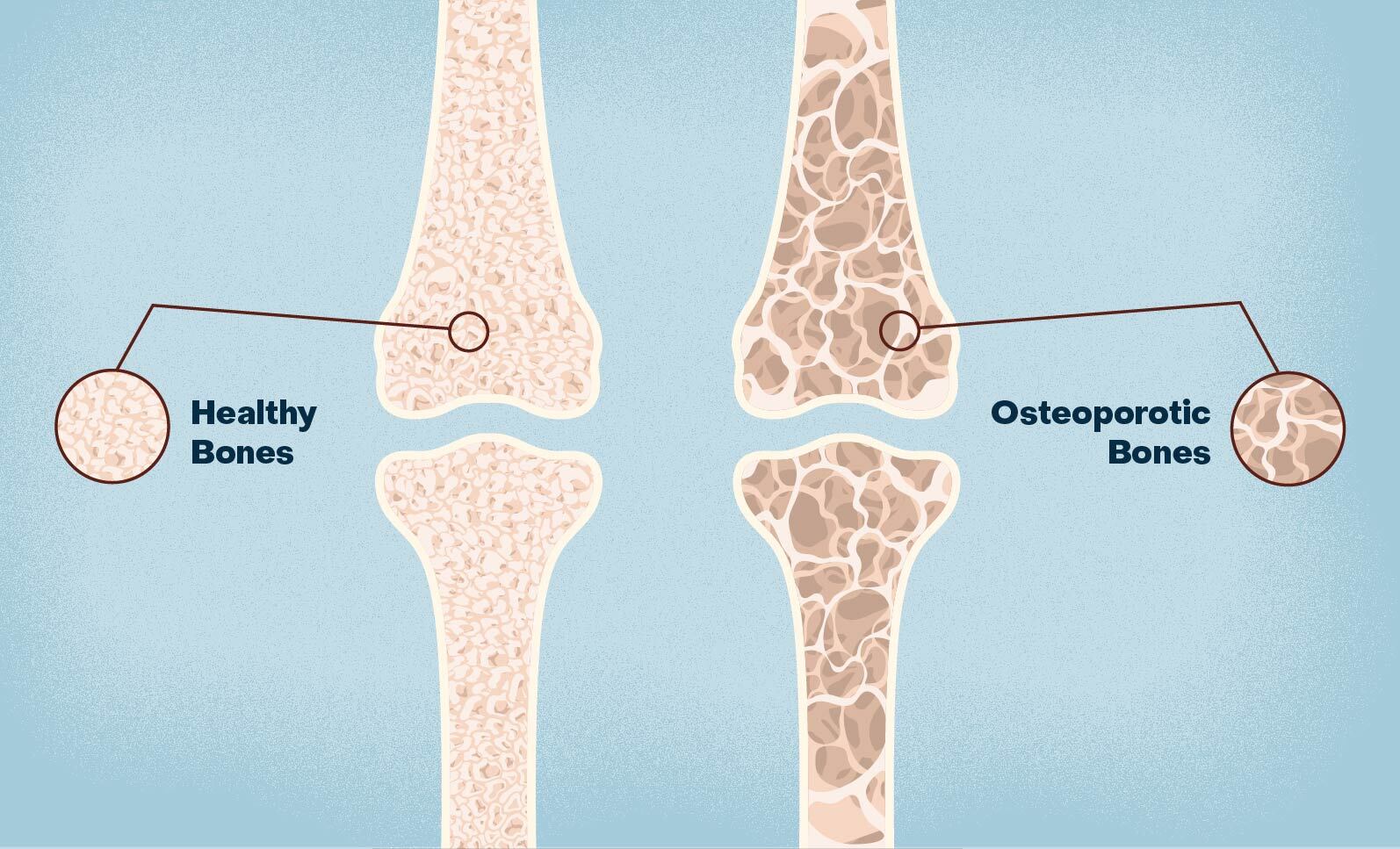 [Image: osteoporosis-22741a150e29419f.jpg]